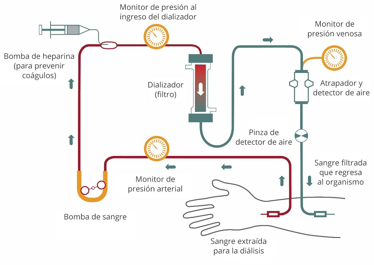 Diagrama del proceso de hemodiálisis